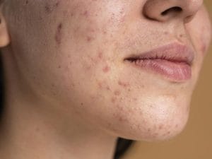 Peel da bị thâm phải làm sao? Bí quyết khắc phục hiệu quả và chăm sóc đúng cách