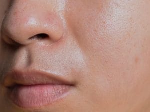 Tại sao dưỡng ẩm da vẫn đổ dầu? Tìm hiểu nguyên nhân ngay