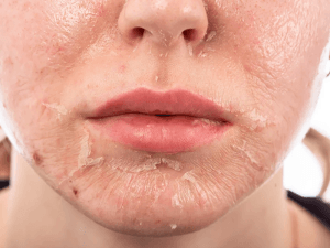 Peel da bị bỏng phải làm sao? Hướng dẫn xử lý an toàn