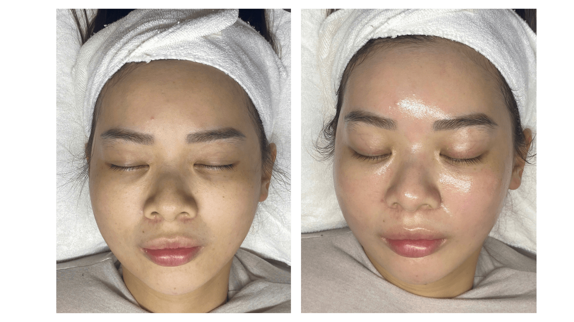 Trước và sau khi sử dụng Meso Infininity