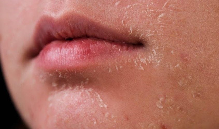 Biểu hiện của da mặt khô bong tróc