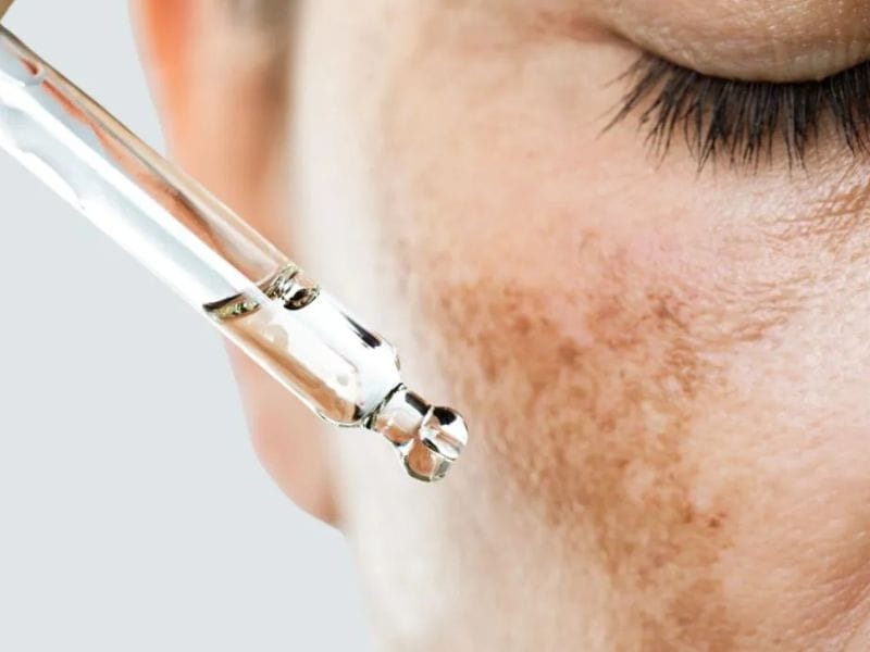 Cách sử dụng các hoạt chất điều trị nám hiệu quả