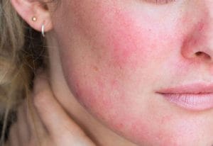 Da bị nhiễm corticoid phải làm sao