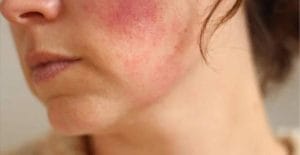 Da nhiễm corticoid