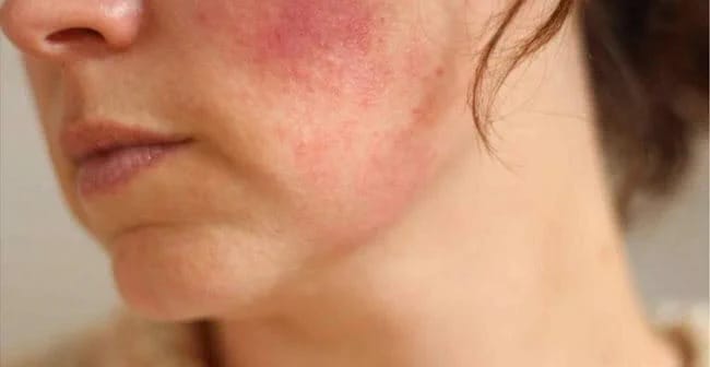 Da nhiễm corticoid
