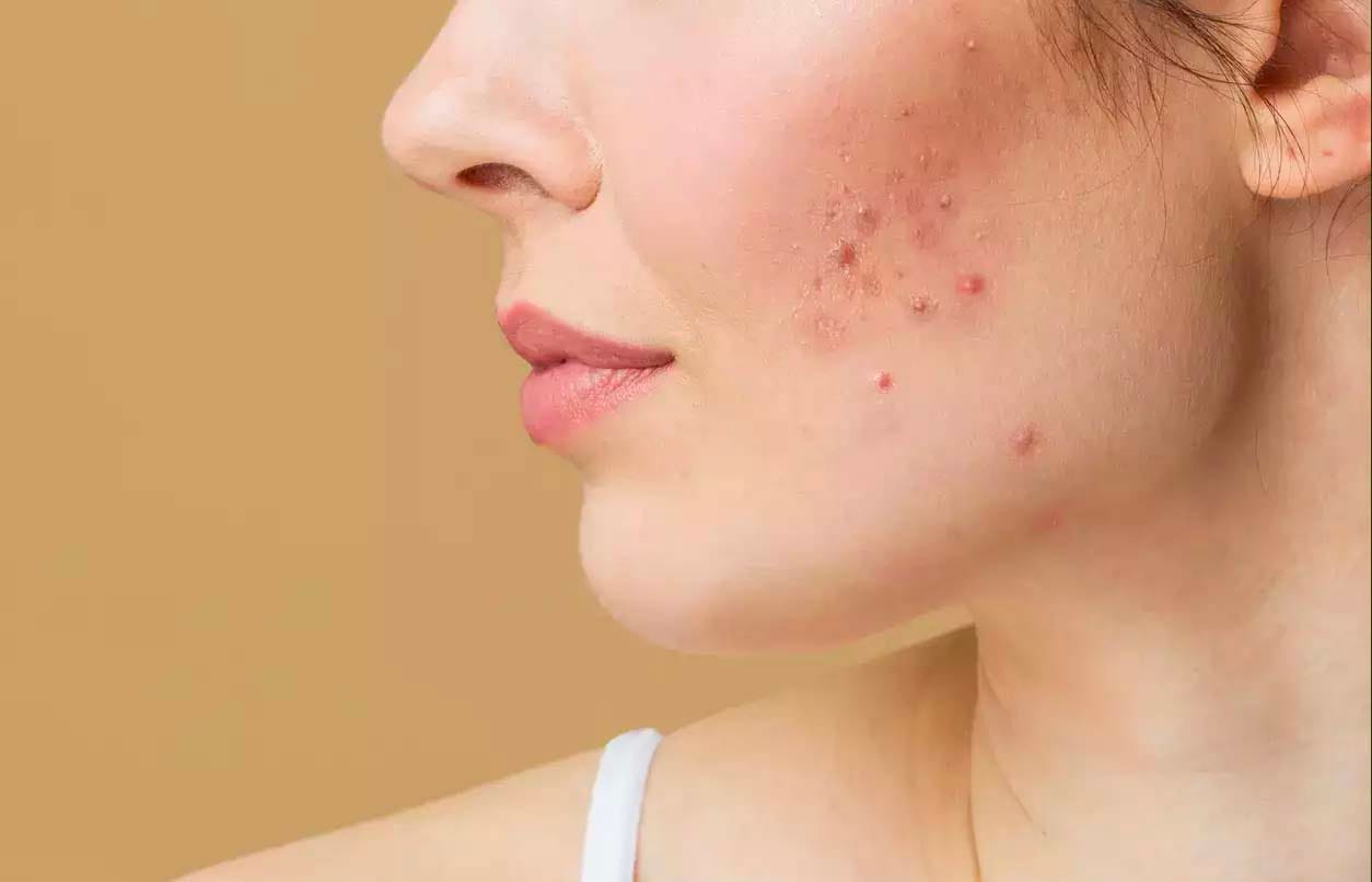 Mặt bị mụn có nên dùng kem chống nắng không