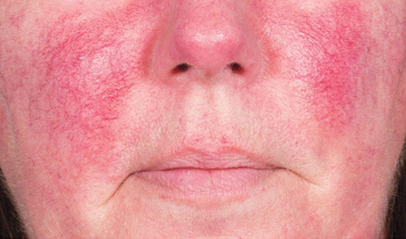 Nguyên nhân da bị nhiễm corticoid