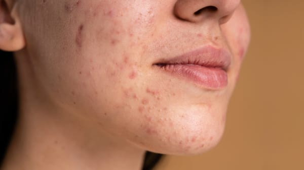 Vì sao dùng kem chống nắng bị mụn