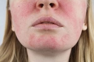 Cách trị Demodex tại nhà hiệu quả