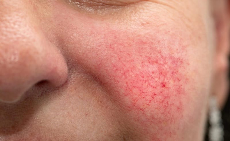 Da bị nhiễm corticoid là gì
