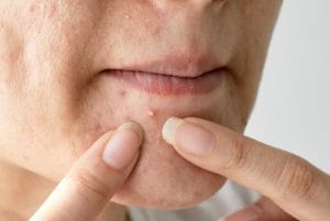 Mụn ở cằm là do đâu
