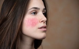 Tại sao da bị nhiễm corticoid
