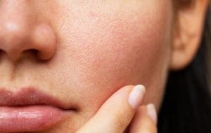 Làm gì khi da bị lão hoá?