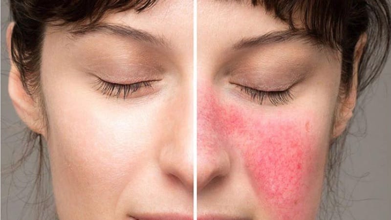 Peel da bị đỏ rát phải làm sao? 