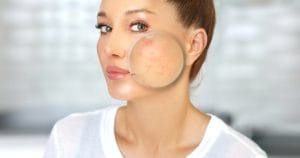 Sau peel da bị đẩy mụn phải làm sao? 