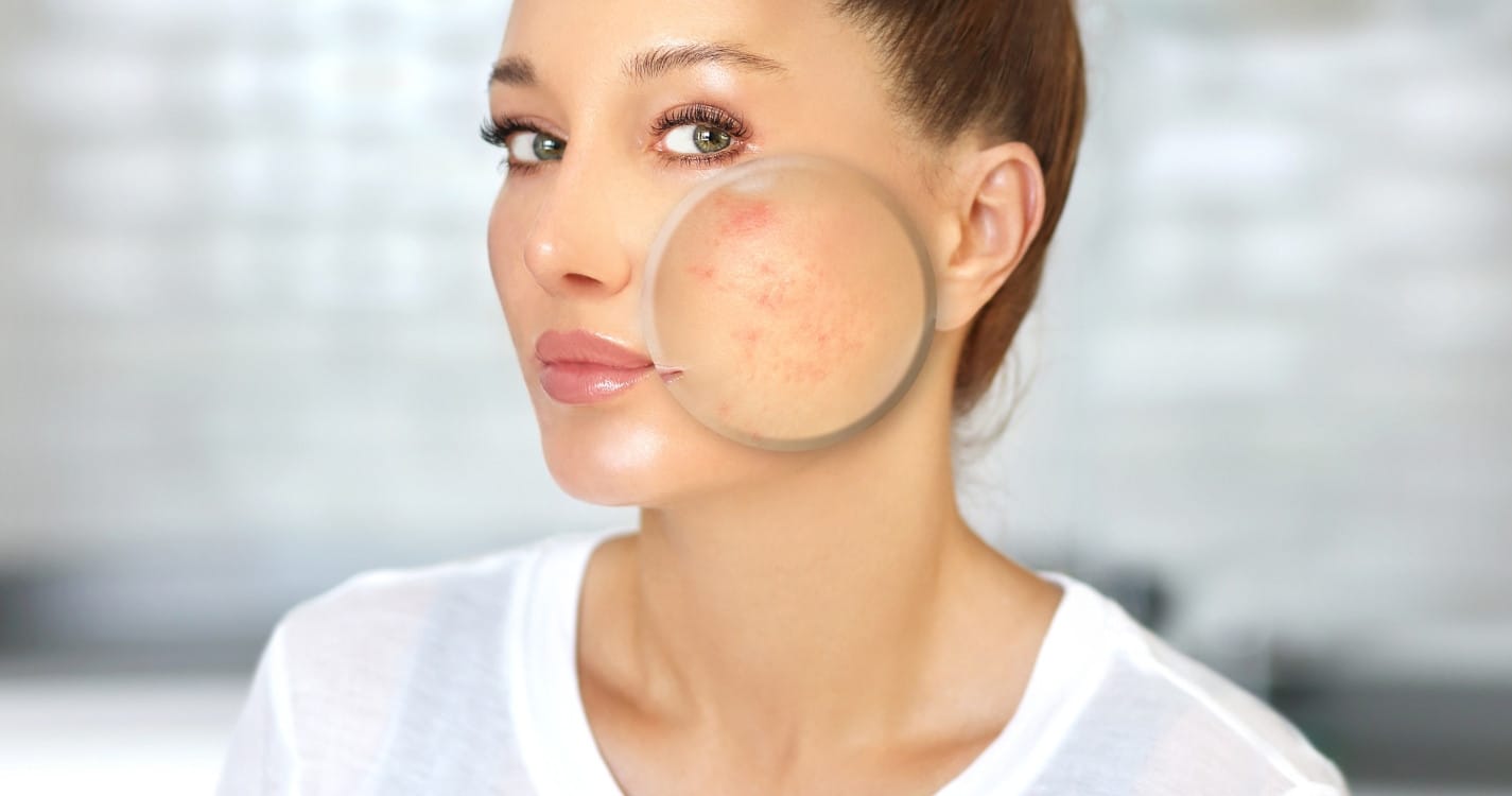 Sau peel da bị đẩy mụn phải làm sao? 