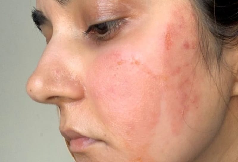 Tại sao sau khi peel da bị đỏ rát? 