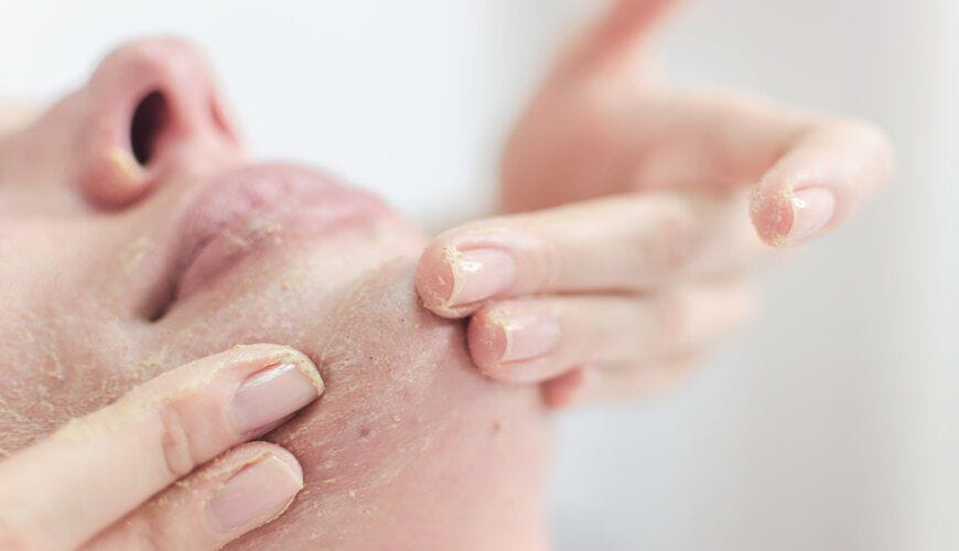 Tình trạng của da đang trong quá trình peel