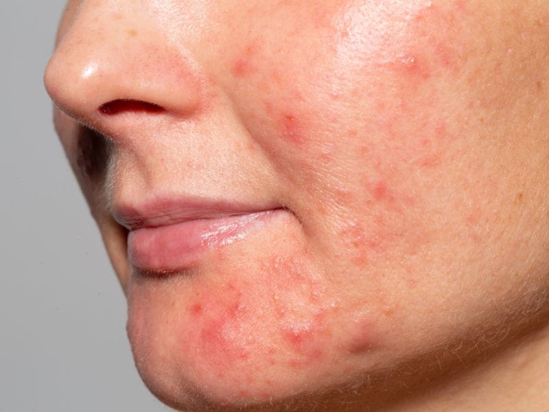 Hướng dẫn lựa chọn sản phẩm peel da trị mụn