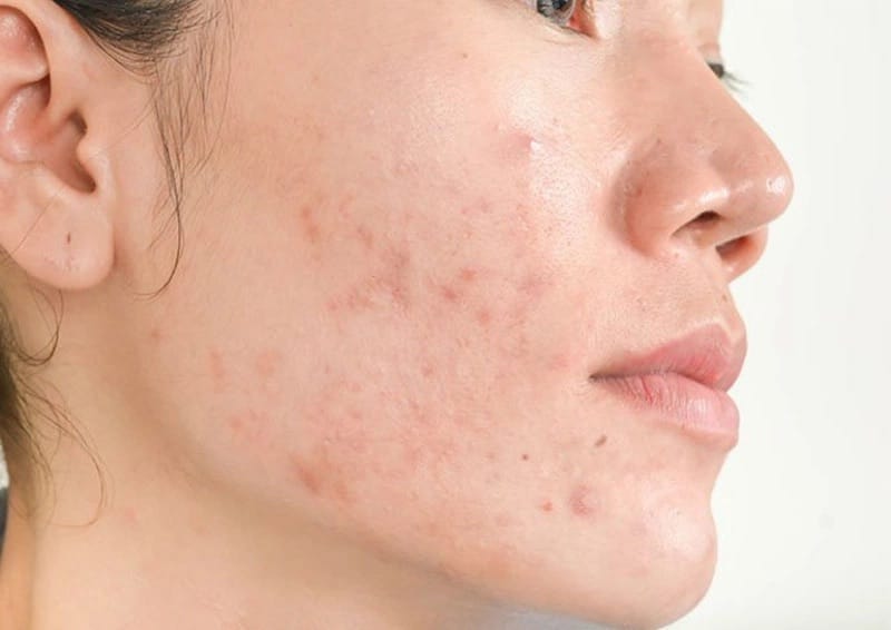 Peel da đẩy mụn trong bao lâu?