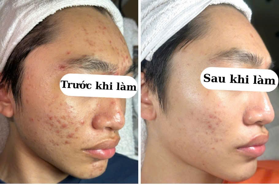 Peel da trước và sau khi dùng Expert Lab