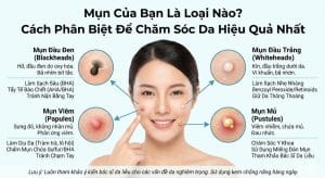 mụn của bạn là loại mụn nào