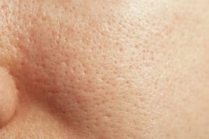 Tắc nghẽn lỗ chân lông là gì?